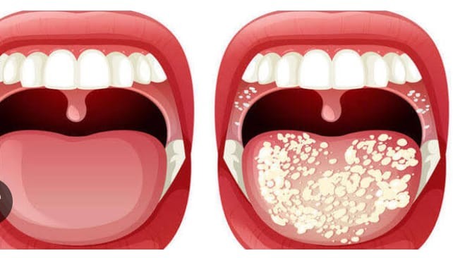 فطريات الفم واللسان