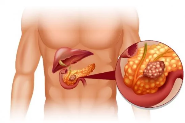 سرطان البنكرياس
