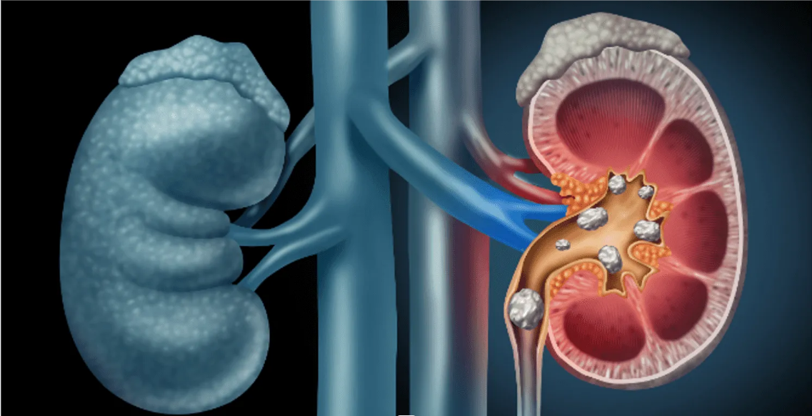  أداة بالذكاء الاصطناعي للكشف المبكر عن سرطان الكلى