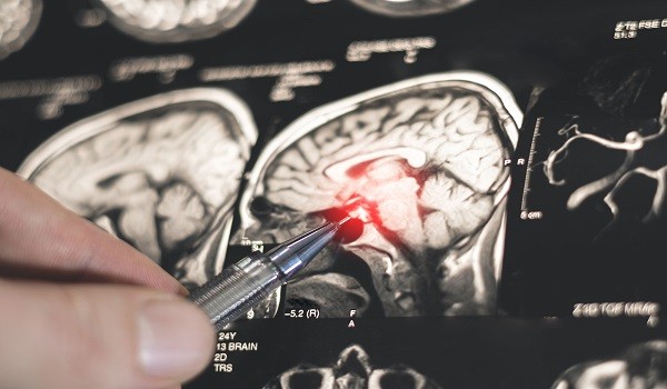 اكتشاف روسي جديد يفتح الطريق لتطوير أدوية لعلاج باركنسون