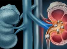  أداة بالذكاء الاصطناعي للكشف المبكر عن سرطان الكلى